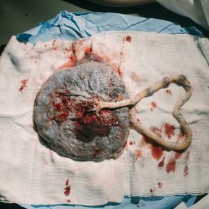 Imagen de una placenta